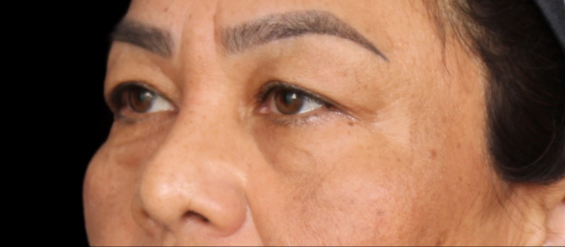 Blepharoplasty Before & After Image