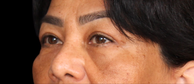 Blepharoplasty Before & After Image