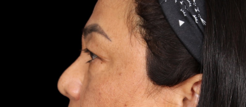 Blepharoplasty Before & After Image