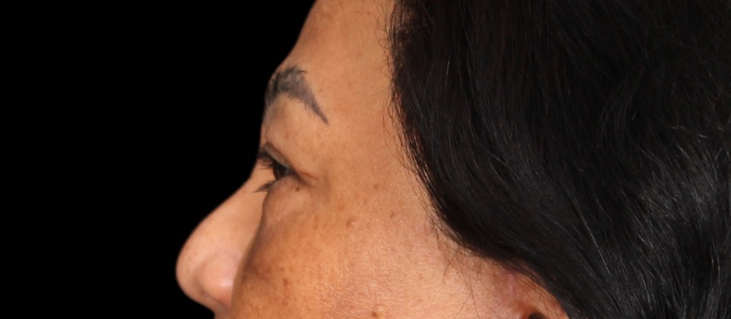 Blepharoplasty Before & After Image