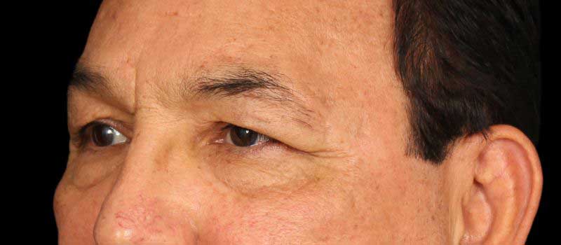 Blepharoplasty Before & After Image