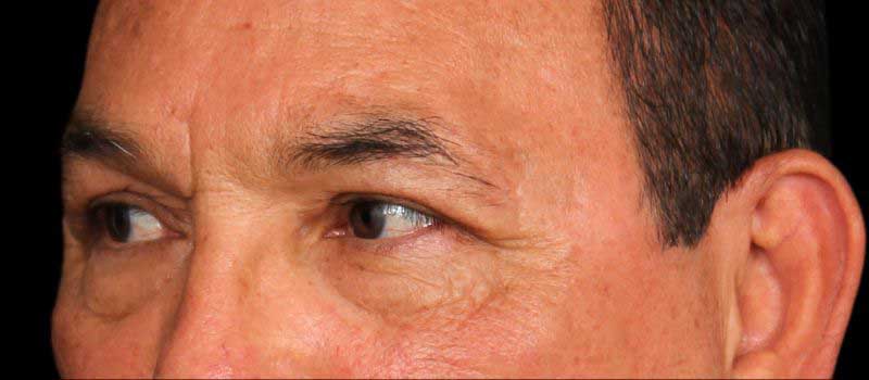 Blepharoplasty Before & After Image