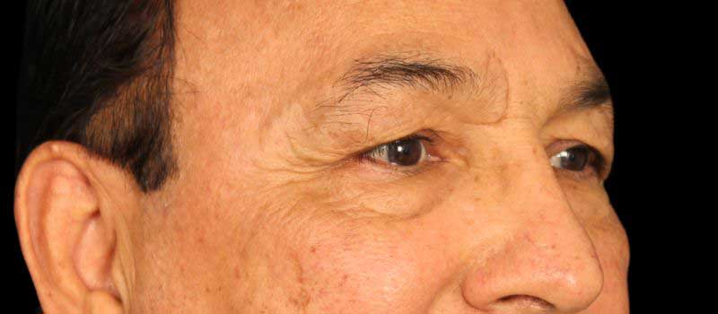 Blepharoplasty Before & After Image