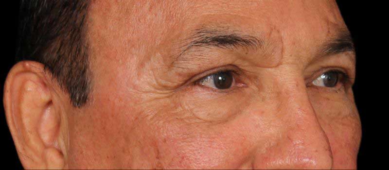 Blepharoplasty Before & After Image