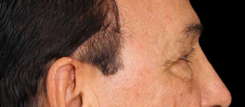 Blepharoplasty Before & After Image