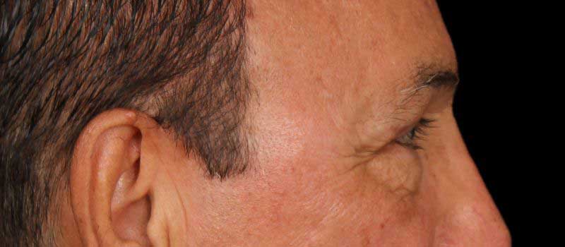 Blepharoplasty Before & After Image