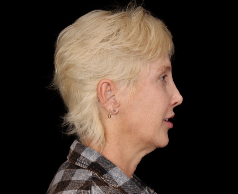 Deep Plane Facelift Before & After Photo