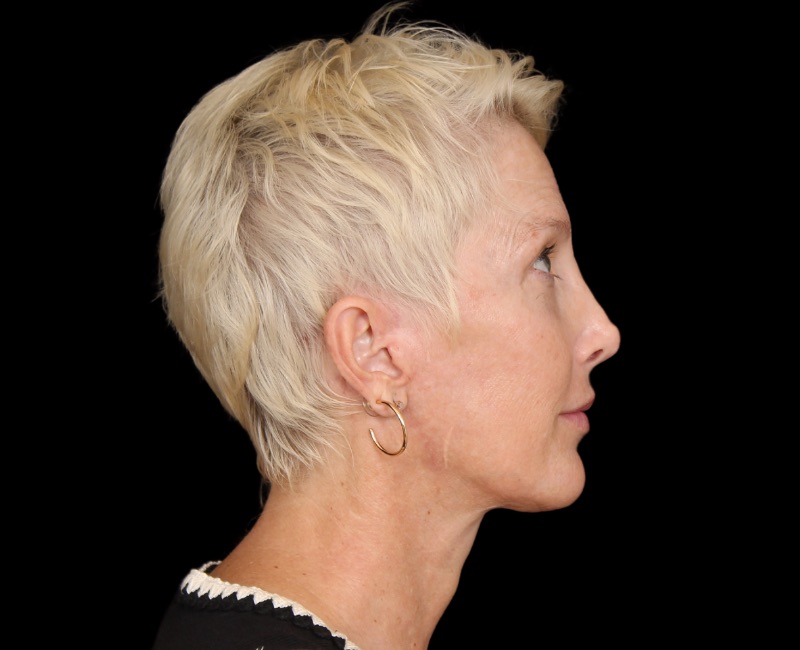 Deep Plane Facelift Before & After Photo