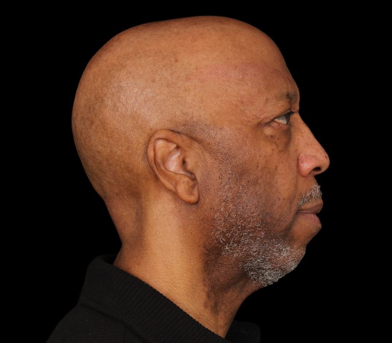Chin implant Before & After Image