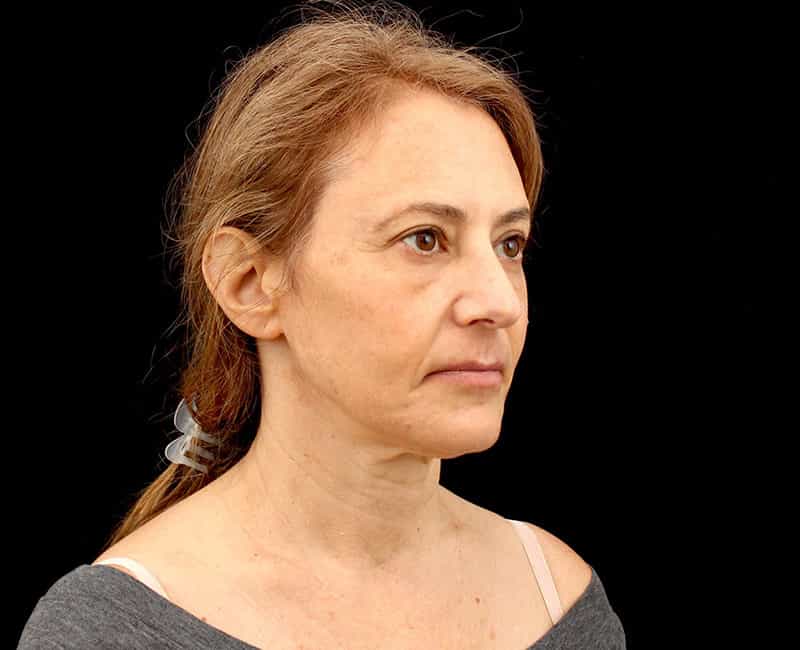 Mid facelift Before & After Image