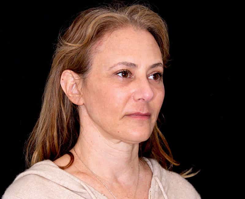 Mid facelift Before & After Image