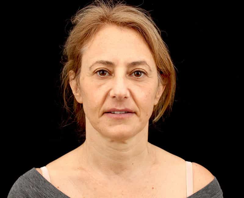 Mid facelift Before & After Image