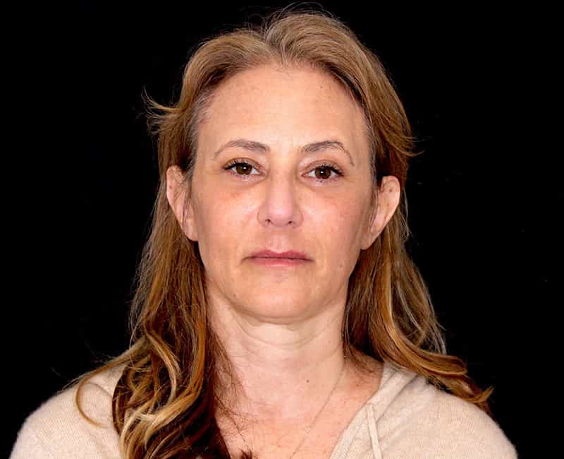 Mid facelift Before & After Image