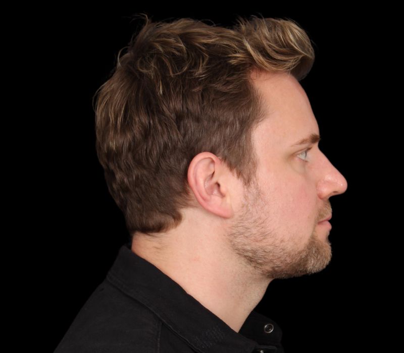 Neck contouring Before & After Image