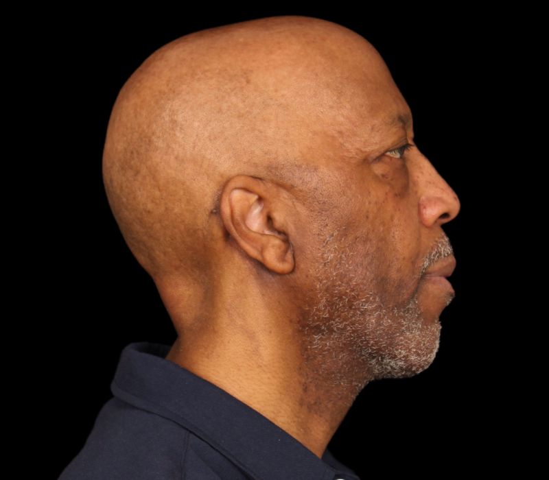Neck lift Before & After Image