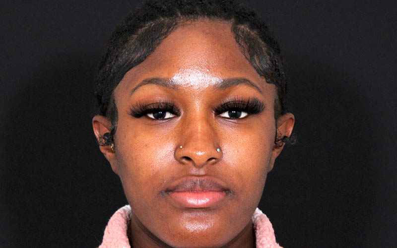 Otoplasty Before & After Image