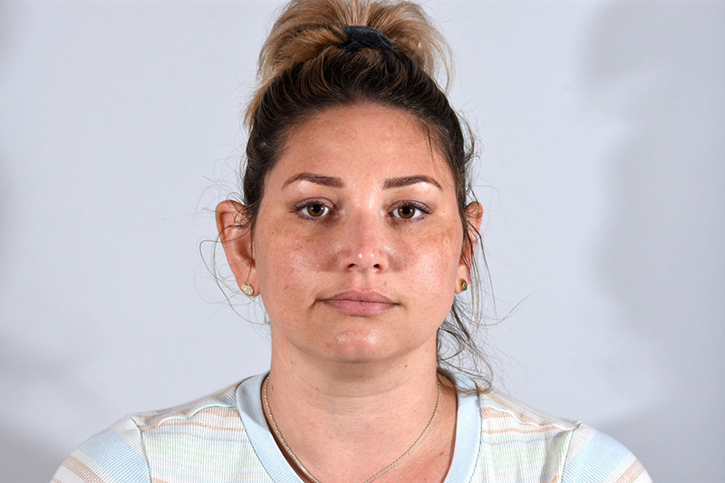 Otoplasty Before & After Image