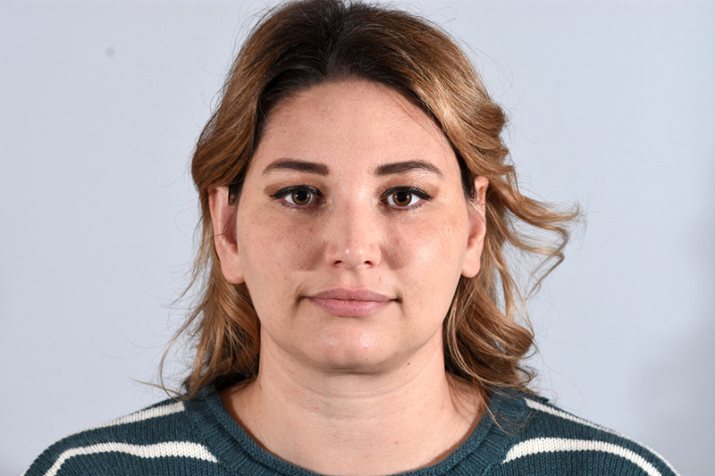 Otoplasty Before & After Image