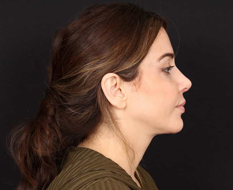 Rhinoplasty Before & After Image