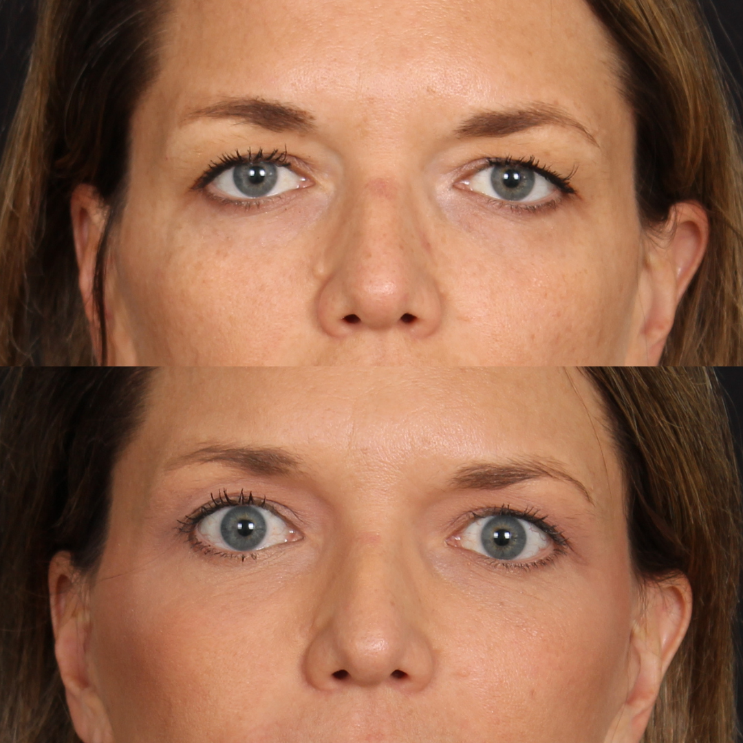 Lateral Brow Lift – Patient 1 Front View
