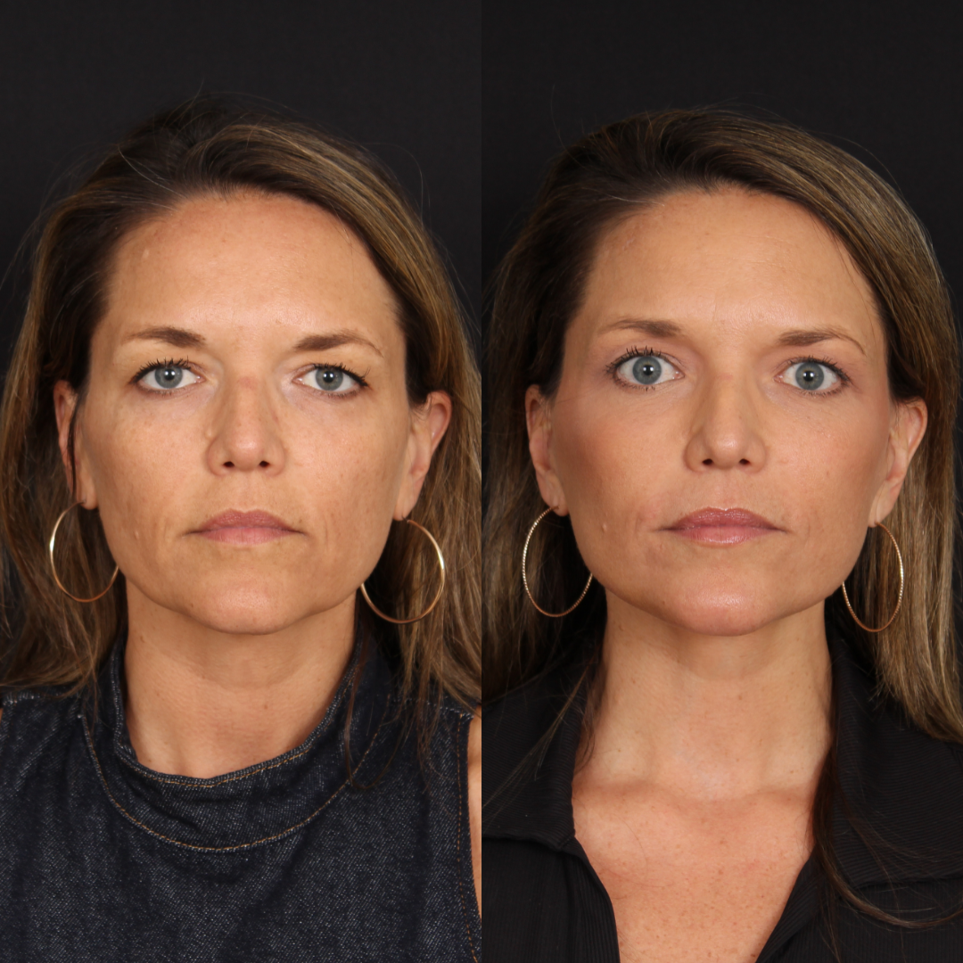 Lateral Brow Lift – Patient 1 Full Front
