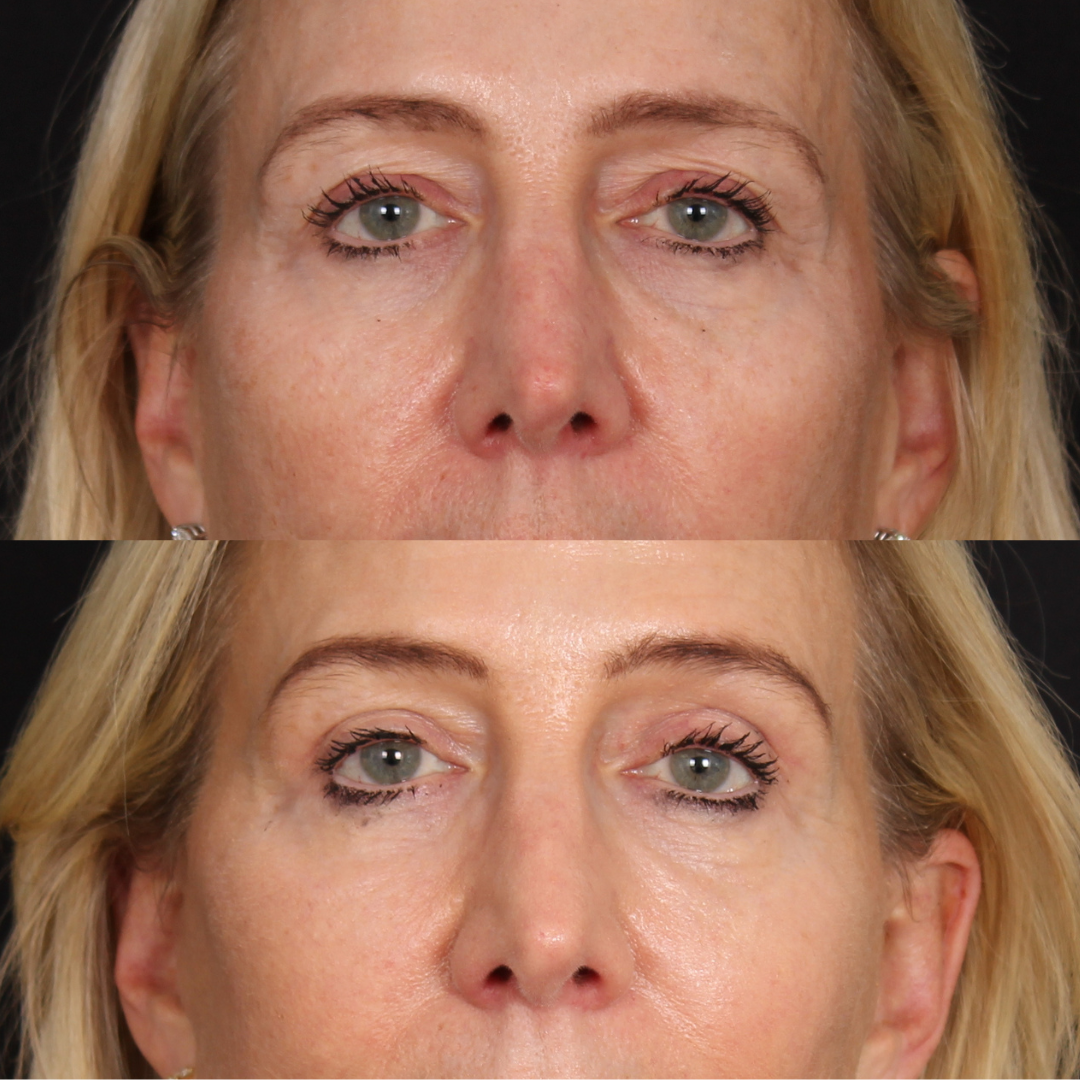 Lateral Brow Lift – Patient 2 Front View