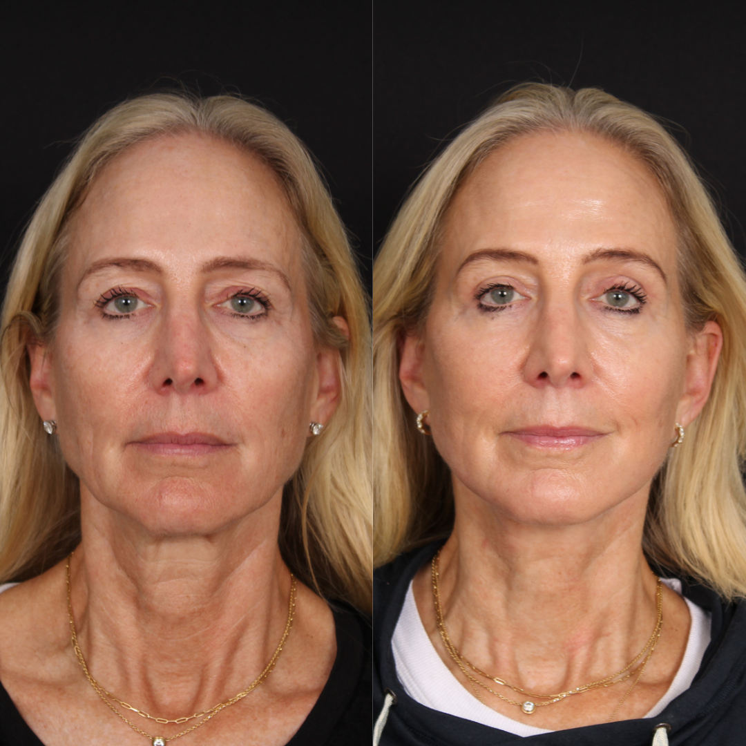 Lateral Brow Lift – Patient 2 Full Front